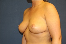 Breast Lift After Photo by Laurence Glickman, MD, MSc, FRCS(c),  FACS; Garden City, NY - Case 29121