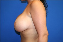 Breast Lift Before Photo by Laurence Glickman, MD, MSc, FRCS(c),  FACS; Garden City, NY - Case 29121
