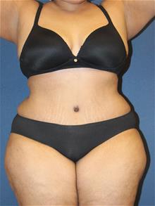 Tummy Tuck After Photo by Laurence Glickman, MD, MSc, FRCS(c),  FACS; Garden City, NY - Case 29122