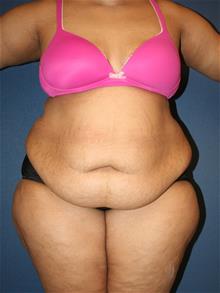 Tummy Tuck Before Photo by Laurence Glickman, MD, MSc, FRCS(c),  FACS; Garden City, NY - Case 29122