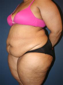 Tummy Tuck Before Photo by Laurence Glickman, MD, MSc, FRCS(c),  FACS; Garden City, NY - Case 29122