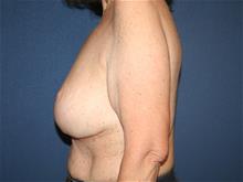 Breast Lift After Photo by Laurence Glickman, MD, MSc, FRCS(c),  FACS; Garden City, NY - Case 29123