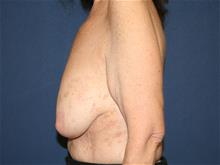 Breast Lift Before Photo by Laurence Glickman, MD, MSc, FRCS(c),  FACS; Garden City, NY - Case 29123