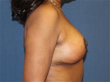 Breast Lift After Photo by Laurence Glickman, MD, MSc, FRCS(c),  FACS; Garden City, NY - Case 29124