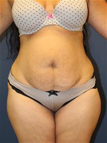 Tummy Tuck Before Photo by Laurence Glickman, MD, MSc, FRCS(c),  FACS; Garden City, NY - Case 29125
