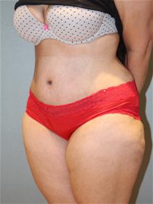 Tummy Tuck After Photo by Laurence Glickman, MD, MSc, FRCS(c),  FACS; Garden City, NY - Case 29125