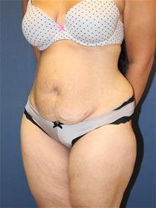 Tummy Tuck Before Photo by Laurence Glickman, MD, MSc, FRCS(c),  FACS; Garden City, NY - Case 29125