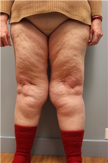 Liposuction Before Photo by Laurence Glickman, MD, MSc, FRCS(c),  FACS; Garden City, NY - Case 30216