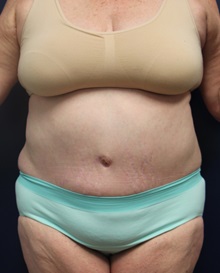 Tummy Tuck After Photo by Laurence Glickman, MD, MSc, FRCS(c),  FACS; Garden City, NY - Case 30218
