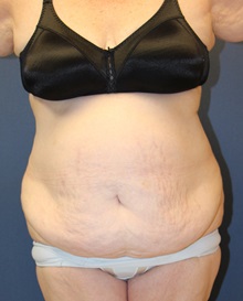 Tummy Tuck Before Photo by Laurence Glickman, MD, MSc, FRCS(c),  FACS; Garden City, NY - Case 30218