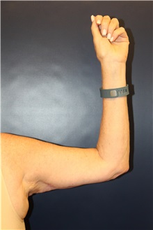 Arm Lift After Photo by Laurence Glickman, MD, MSc, FRCS(c),  FACS; Garden City, NY - Case 30219