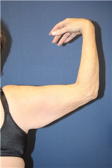 Arm Lift Before Photo by Laurence Glickman, MD, MSc, FRCS(c),  FACS; Garden City, NY - Case 30219