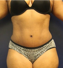 Tummy Tuck After Photo by Laurence Glickman, MD, MSc, FRCS(c),  FACS; Garden City, NY - Case 30224