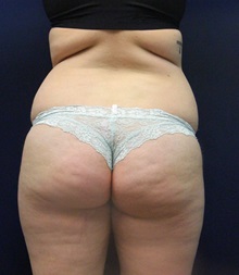 Liposuction Before Photo by Laurence Glickman, MD, MSc, FRCS(c),  FACS; Garden City, NY - Case 30227