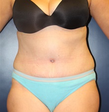 Tummy Tuck After Photo by Laurence Glickman, MD, MSc, FRCS(c),  FACS; Garden City, NY - Case 30228