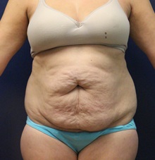Tummy Tuck Before Photo by Laurence Glickman, MD, MSc, FRCS(c),  FACS; Garden City, NY - Case 30228