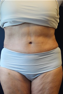 Tummy Tuck After Photo by Laurence Glickman, MD, MSc, FRCS(c),  FACS; Garden City, NY - Case 30234