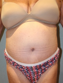 Tummy Tuck After Photo by Laurence Glickman, MD, MSc, FRCS(c),  FACS; Garden City, NY - Case 30237