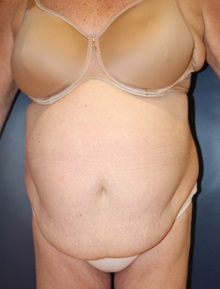 Tummy Tuck Before Photo by Laurence Glickman, MD, MSc, FRCS(c),  FACS; Garden City, NY - Case 30237