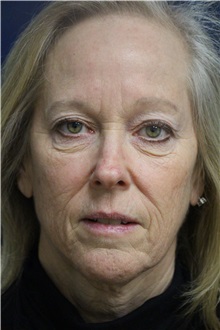 Eyelid Surgery Before Photo by Laurence Glickman, MD, MSc, FRCS(c),  FACS; Garden City, NY - Case 30238