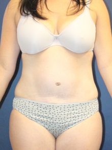 Tummy Tuck After Photo by Laurence Glickman, MD, MSc, FRCS(c),  FACS; Garden City, NY - Case 30240
