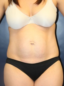 Tummy Tuck Before Photo by Laurence Glickman, MD, MSc, FRCS(c),  FACS; Garden City, NY - Case 30240