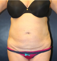 Tummy Tuck Before Photo by Laurence Glickman, MD, MSc, FRCS(c),  FACS; Garden City, NY - Case 30241