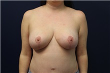 Breast Lift After Photo by Laurence Glickman, MD, MSc, FRCS(c),  FACS; Garden City, NY - Case 30242