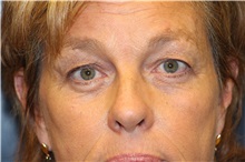 Eyelid Surgery Before Photo by Laurence Glickman, MD, MSc, FRCS(c),  FACS; Garden City, NY - Case 30245