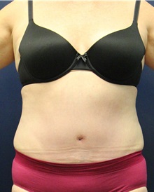 Tummy Tuck After Photo by Laurence Glickman, MD, MSc, FRCS(c),  FACS; Garden City, NY - Case 30246