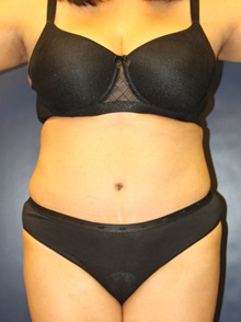 Tummy Tuck After Photo by Laurence Glickman, MD, MSc, FRCS(c),  FACS; Garden City, NY - Case 30247