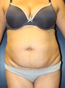Tummy Tuck Before Photo by Laurence Glickman, MD, MSc, FRCS(c),  FACS; Garden City, NY - Case 30247