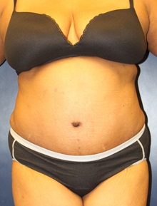 Tummy Tuck After Photo by Laurence Glickman, MD, MSc, FRCS(c),  FACS; Garden City, NY - Case 30250