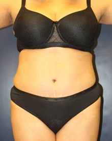 Tummy Tuck After Photo by Laurence Glickman, MD, MSc, FRCS(c),  FACS; Garden City, NY - Case 30255