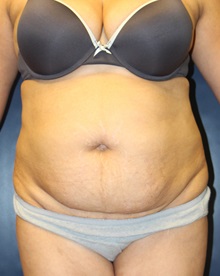 Tummy Tuck Before Photo by Laurence Glickman, MD, MSc, FRCS(c),  FACS; Garden City, NY - Case 30255