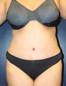 Tummy Tuck After Photo by Laurence Glickman, MD, MSc, FRCS(c),  FACS; Garden City, NY - Case 30256