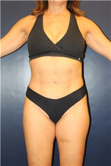 Liposuction After Photo by Laurence Glickman, MD, MSc, FRCS(c),  FACS; Garden City, NY - Case 30262