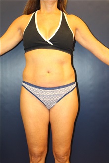 Liposuction Before Photo by Laurence Glickman, MD, MSc, FRCS(c),  FACS; Garden City, NY - Case 30262