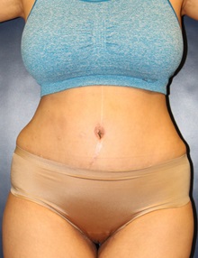 Tummy Tuck After Photo by Laurence Glickman, MD, MSc, FRCS(c),  FACS; Garden City, NY - Case 30266