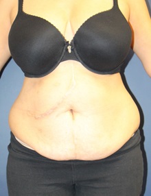 Tummy Tuck Before Photo by Laurence Glickman, MD, MSc, FRCS(c),  FACS; Garden City, NY - Case 30266