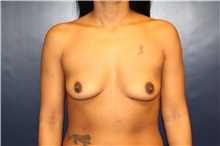Breast Augmentation Before Photo by Laurence Glickman, MD, MSc, FRCS(c),  FACS; Garden City, NY - Case 30267