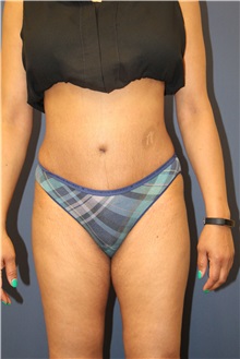 Tummy Tuck After Photo by Laurence Glickman, MD, MSc, FRCS(c),  FACS; Garden City, NY - Case 30268