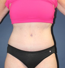 Tummy Tuck After Photo by Laurence Glickman, MD, MSc, FRCS(c),  FACS; Garden City, NY - Case 30271