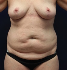 Tummy Tuck Before Photo by Laurence Glickman, MD, MSc, FRCS(c),  FACS; Garden City, NY - Case 30271