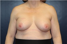 Breast Augmentation After Photo by Laurence Glickman, MD, MSc, FRCS(c),  FACS; Garden City, NY - Case 30278