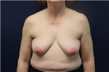 Breast Augmentation Before Photo by Laurence Glickman, MD, MSc, FRCS(c),  FACS; Garden City, NY - Case 30278