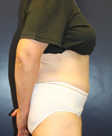 Tummy Tuck After Photo by Laurence Glickman, MD, MSc, FRCS(c),  FACS; Garden City, NY - Case 34816