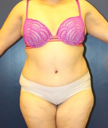 Tummy Tuck After Photo by Laurence Glickman, MD, MSc, FRCS(c),  FACS; Garden City, NY - Case 34817