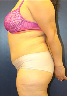 Tummy Tuck After Photo by Laurence Glickman, MD, MSc, FRCS(c),  FACS; Garden City, NY - Case 34817