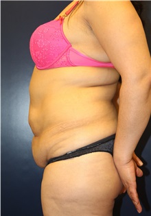 Tummy Tuck Before Photo by Laurence Glickman, MD, MSc, FRCS(c),  FACS; Garden City, NY - Case 34817